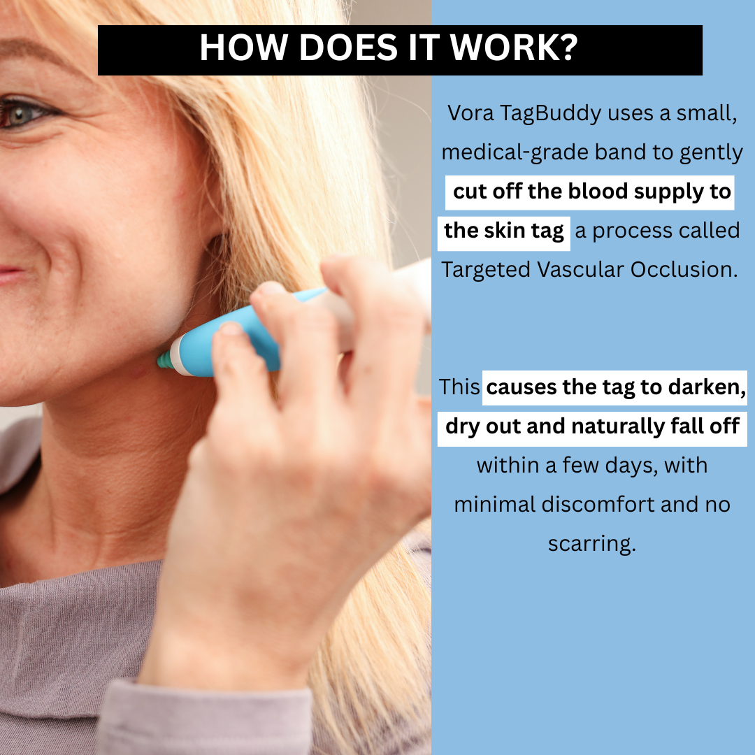 TagBuddy Kit - No More Skin Tags
