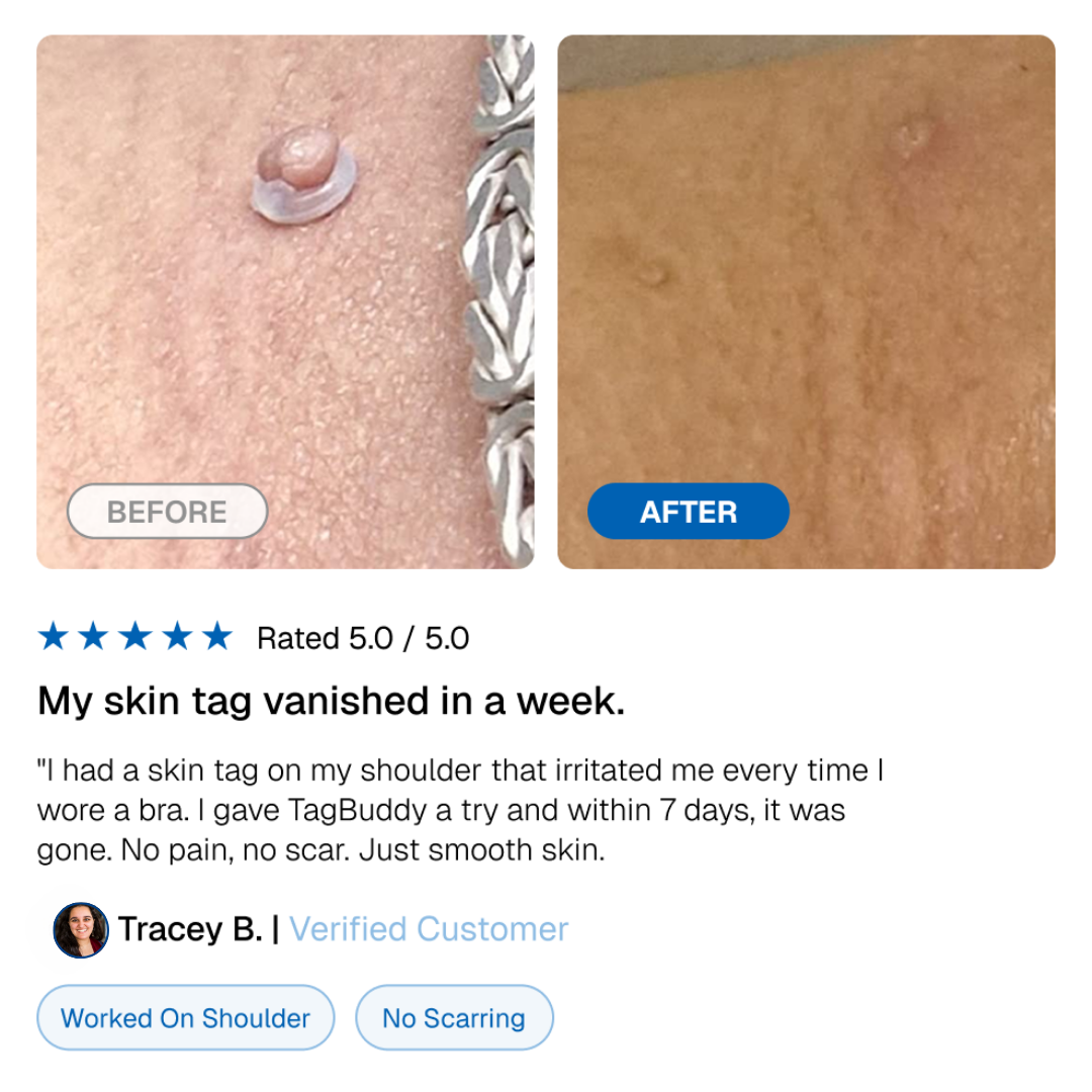 TagBuddy Kit - Slut med skin tags