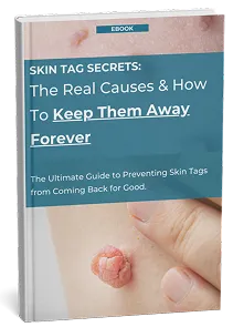 TagBuddy Kit - No More Skin Tags