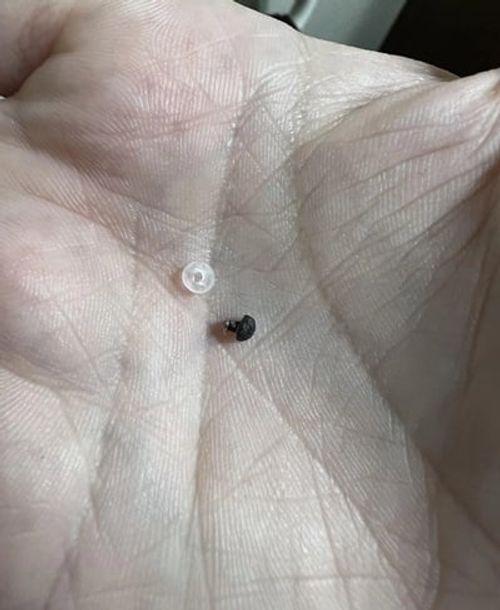 Skin tag band and separated skin tag example