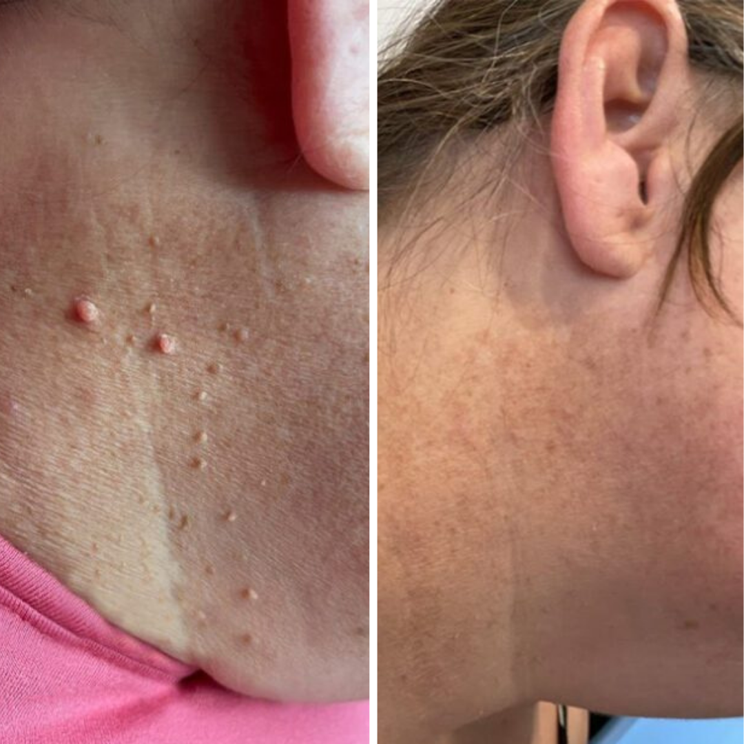 Vora Fibroblast Plasma Pen