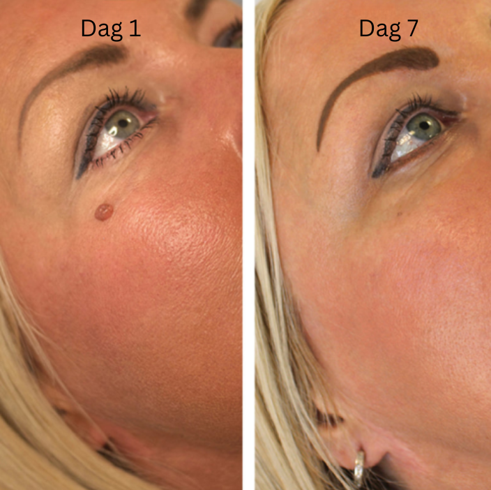 TagBuddy Kit - Slut med skin tags