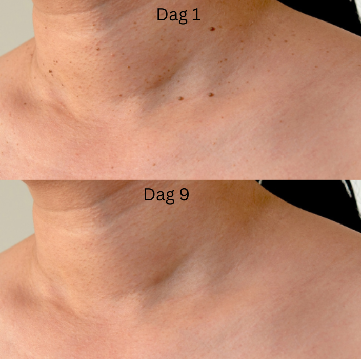 TagBuddy Kit - Slut med skin tags