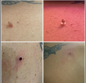Résultat AcroFix™ – Emma R.