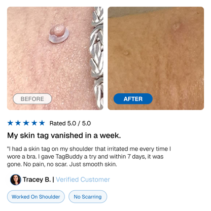 TagBuddy Kit - No More Skin Tags