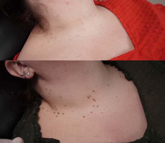 Vora Fibroblast Plasma Pen