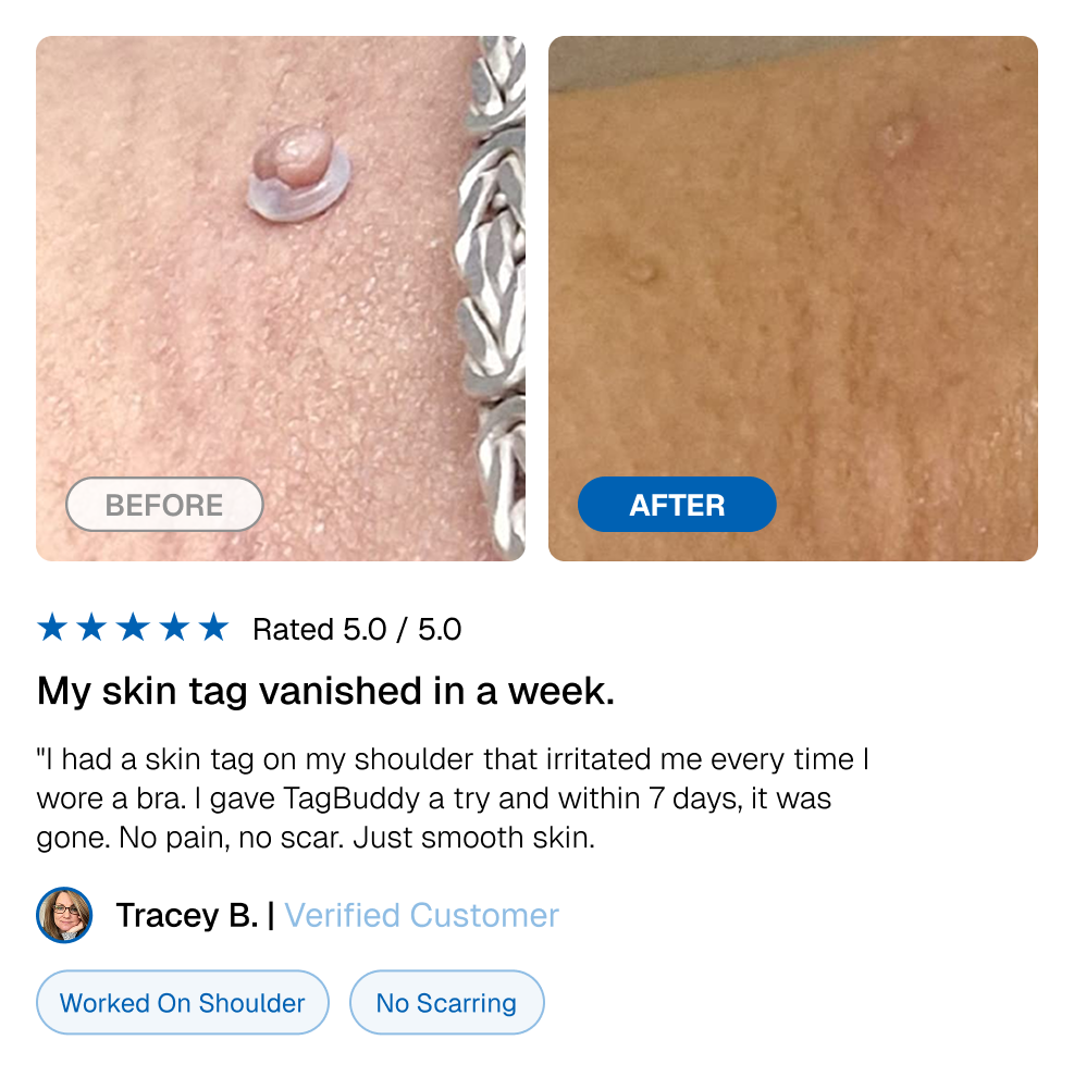 TagBuddy Kit - No More Skin Tags