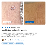 TagBuddy Kit - No More Skin Tags