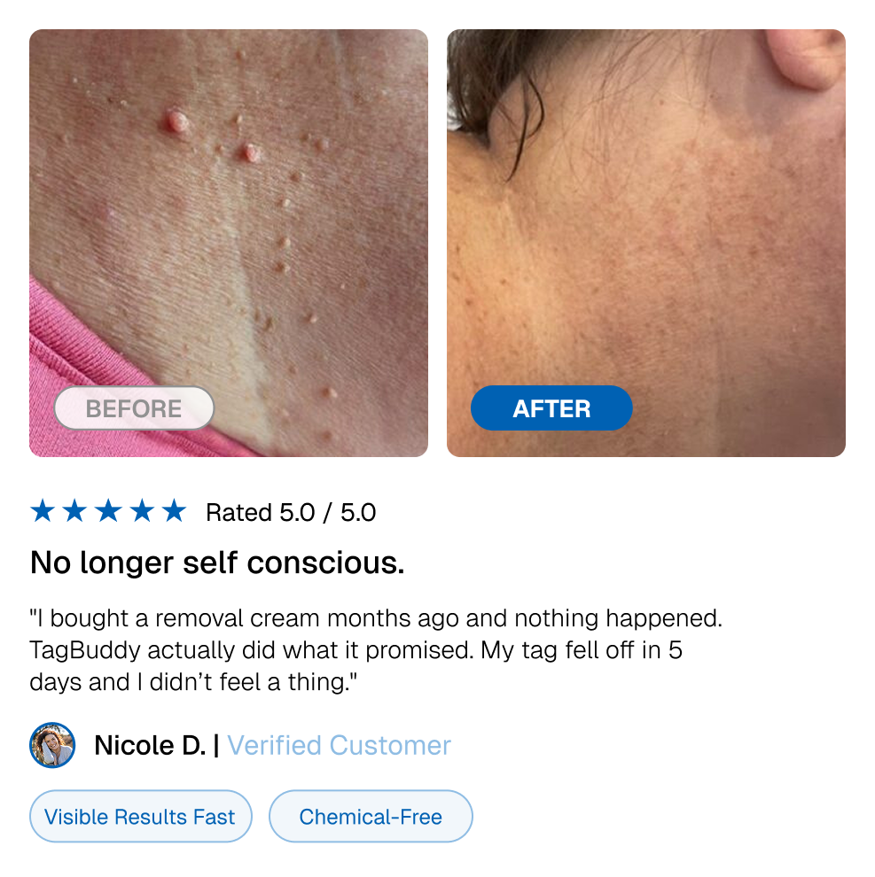 TagBuddy Kit - No More Skin Tags