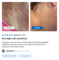 TagBuddy Kit - No More Skin Tags
