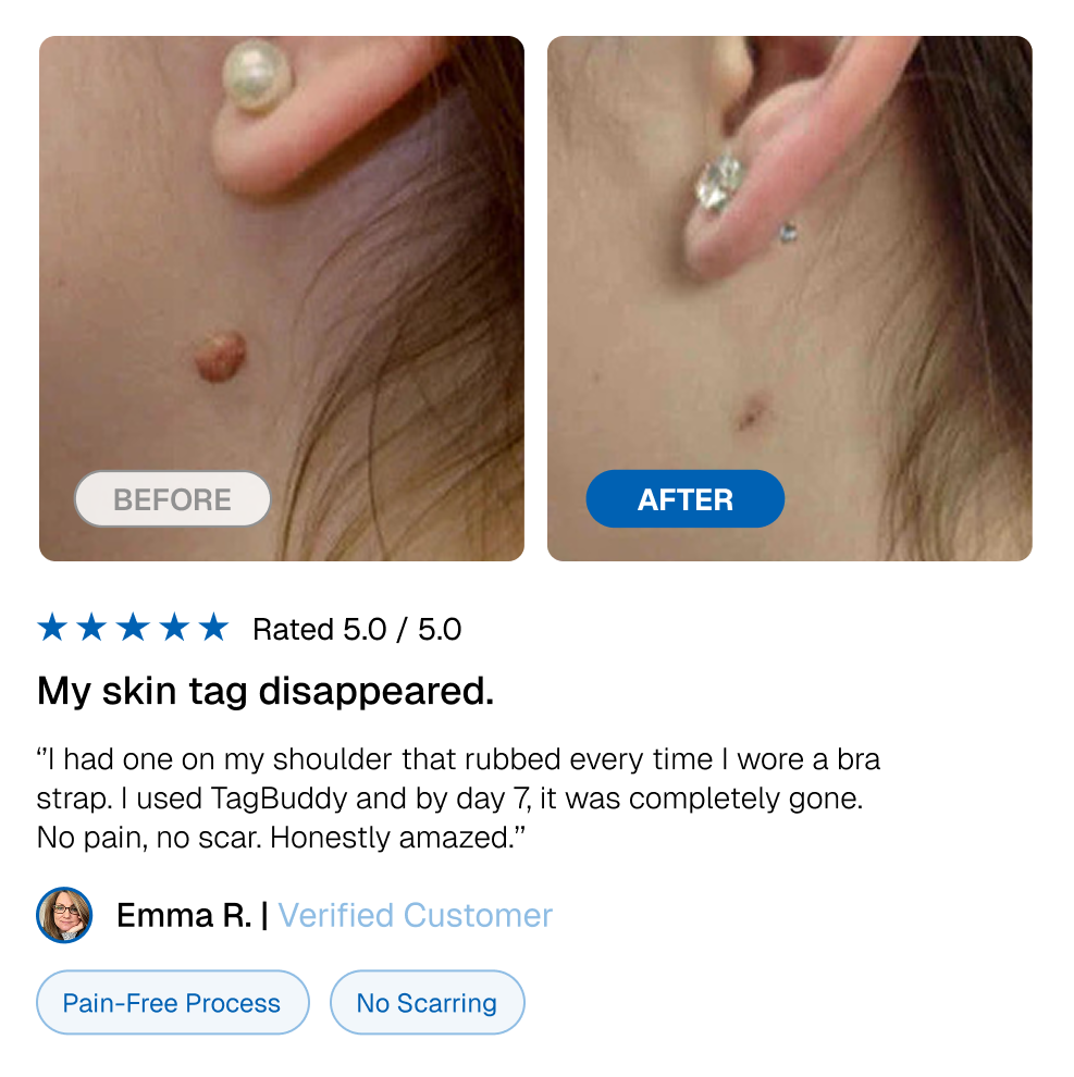 TagBuddy Kit - No More Skin Tags