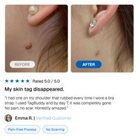TagBuddy Kit - No More Skin Tags